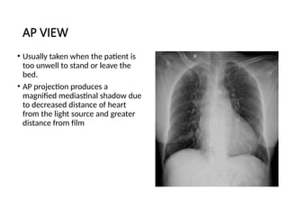 Chest Xray Radiograph Brief explain .pptx