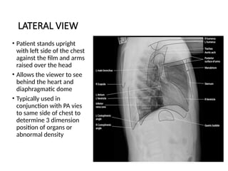 Chest Xray Radiograph Brief explain .pptx