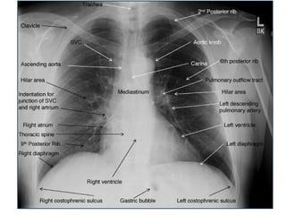 Chest Xray Radiograph Brief explain .pptx