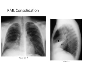 Rml Collapse Radiograph Chest Xray Radiograph Brief explain .pptx