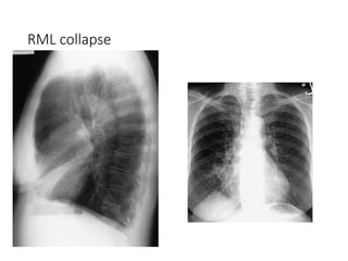 Rml Collapse Radiograph Chest Xray Radiograph Brief explain .pptx