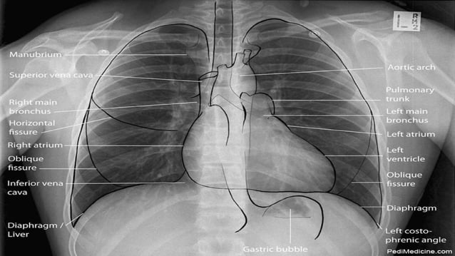 Normal Rug X Ray CHEST XRAY normal anatomy and pathology.pptx