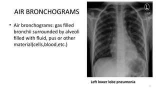 CHEST XRAY normal anatomy and pathology.pptx