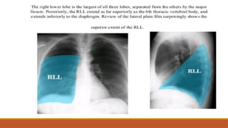 Chest X-Ray Views & Key Radiologic Signs | PPTX