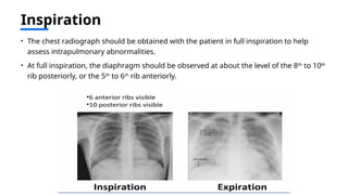 Inspiration Normal Ribs Comprehensive Guide to Chest X-Ray Interpretation and Radiographic ...