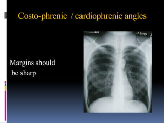 Costo-phrenic / cardiophrenic angles




Margins should
be sharp
 