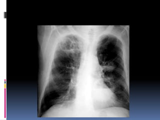 Chest xray  