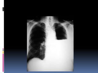 Chest xray  