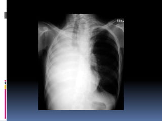Chest xray  