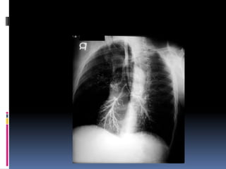 Chest xray  
