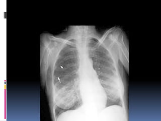 Chest xray  