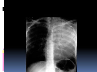 Chest xray  