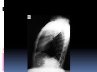 Chest xray  