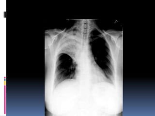 Chest xray  