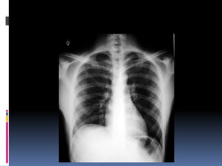 Chest xray  