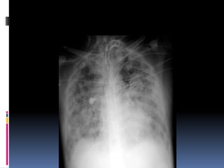 Chest xray  