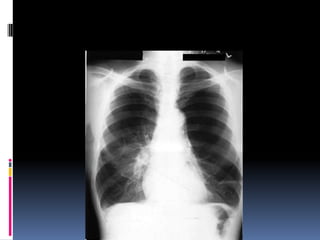 Chest xray  
