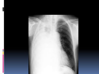 Chest xray  