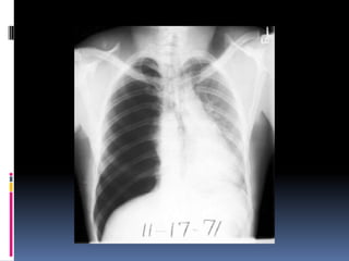Chest xray  