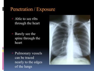 Penetration / Exposure
 Able to see ribs
  through the heart

 Barely see the
  spine through the
  heart

 Pulmonary vessels
  can be traced
  nearly to the edges
  of the lungs
 