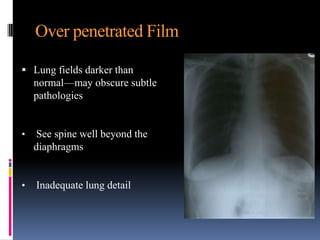 Over penetrated Film

 Lung fields darker than
    normal—may obscure subtle
    pathologies


•   See spine well beyond the
    diaphragms


•   Inadequate lung detail
 
