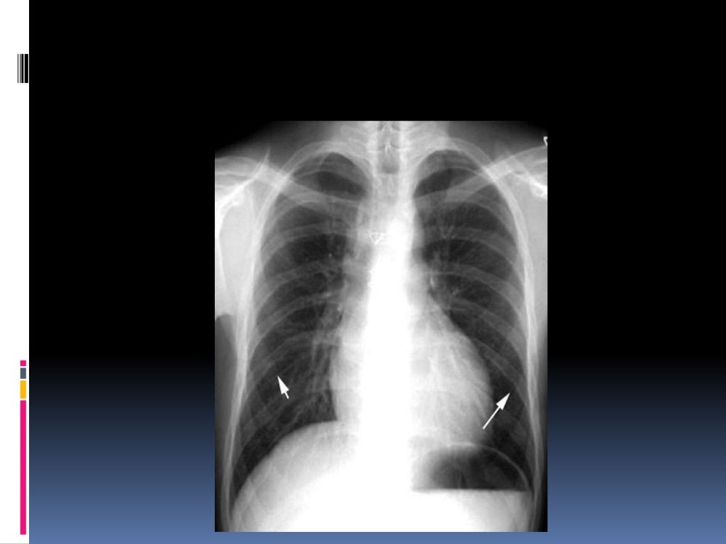 Chest xray