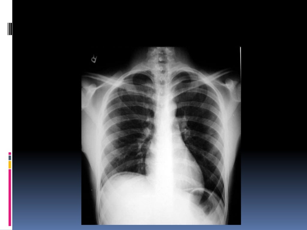 Chest xray