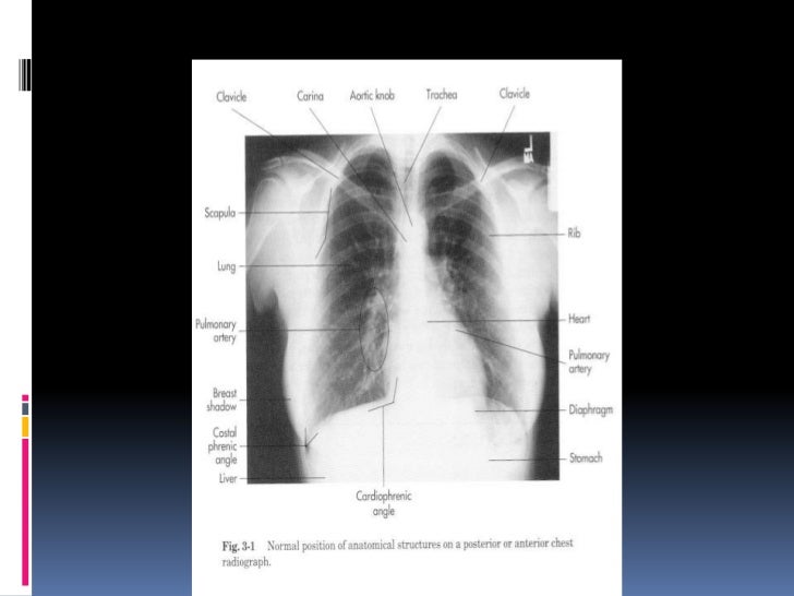 chest xray