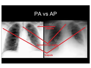 Chest X ray ap and pa view , findings in various diseases | PPTX