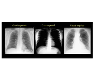 Chest X ray ap and pa view , findings in various diseases | PPTX