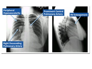 Chest X ray ap and pa view , findings in various diseases | PPTX