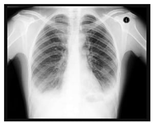Chest X ray ap and pa view , findings in various diseases | PPTX