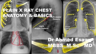 Chest x ray anatomy basics