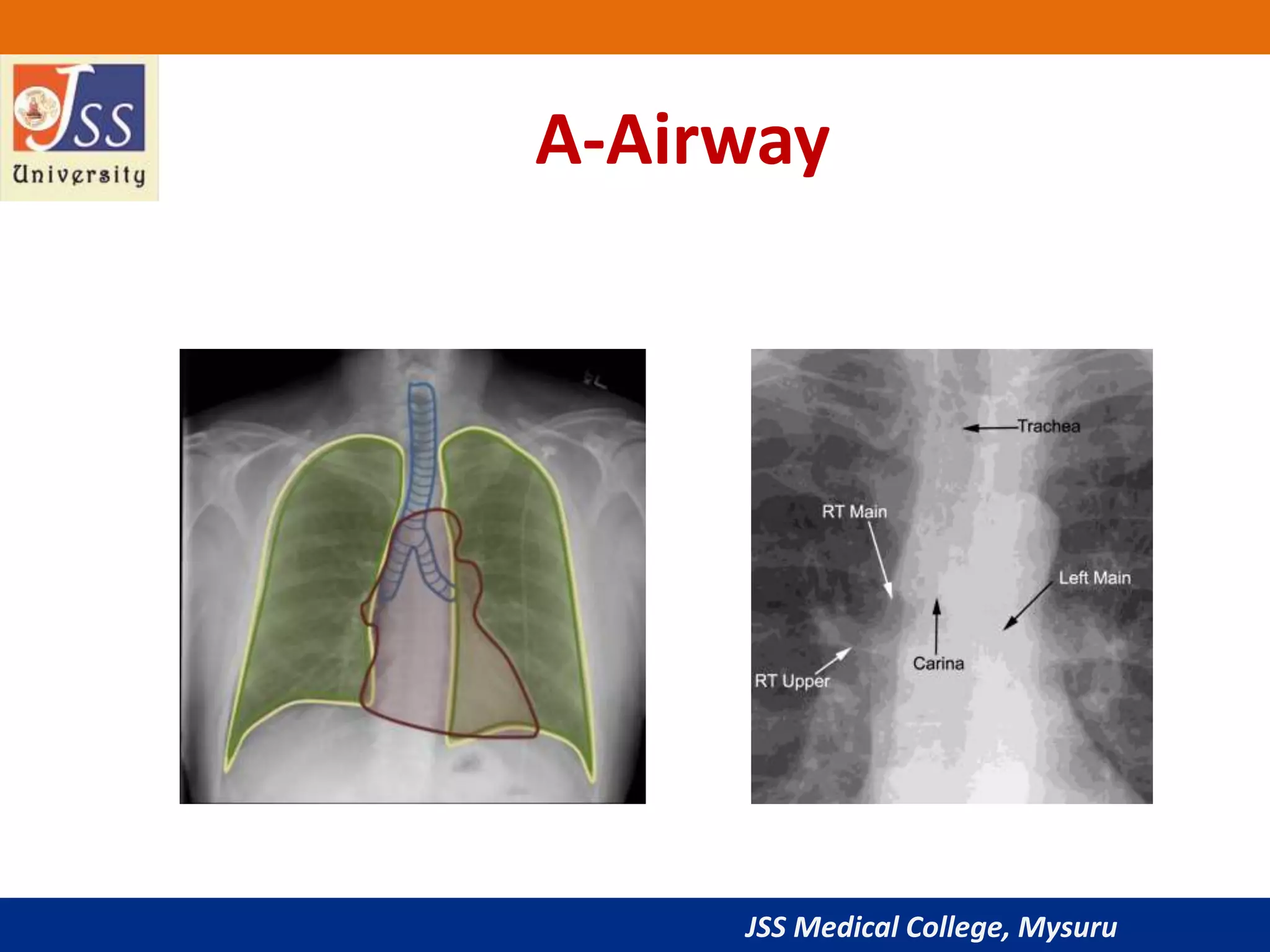 JSS Medical College, Mysuru
A-Airway
 