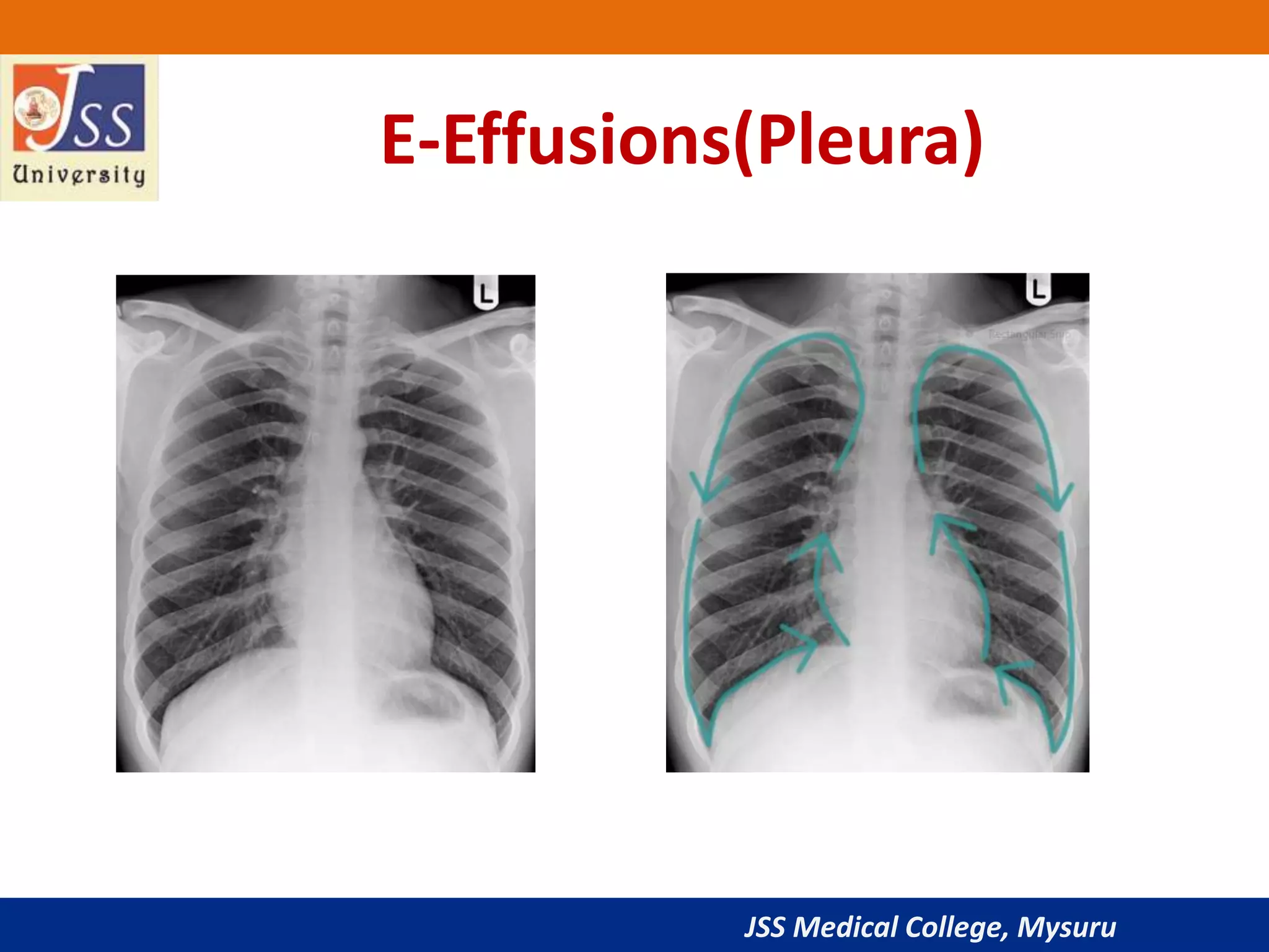JSS Medical College, Mysuru
E-Effusions(Pleura)
 