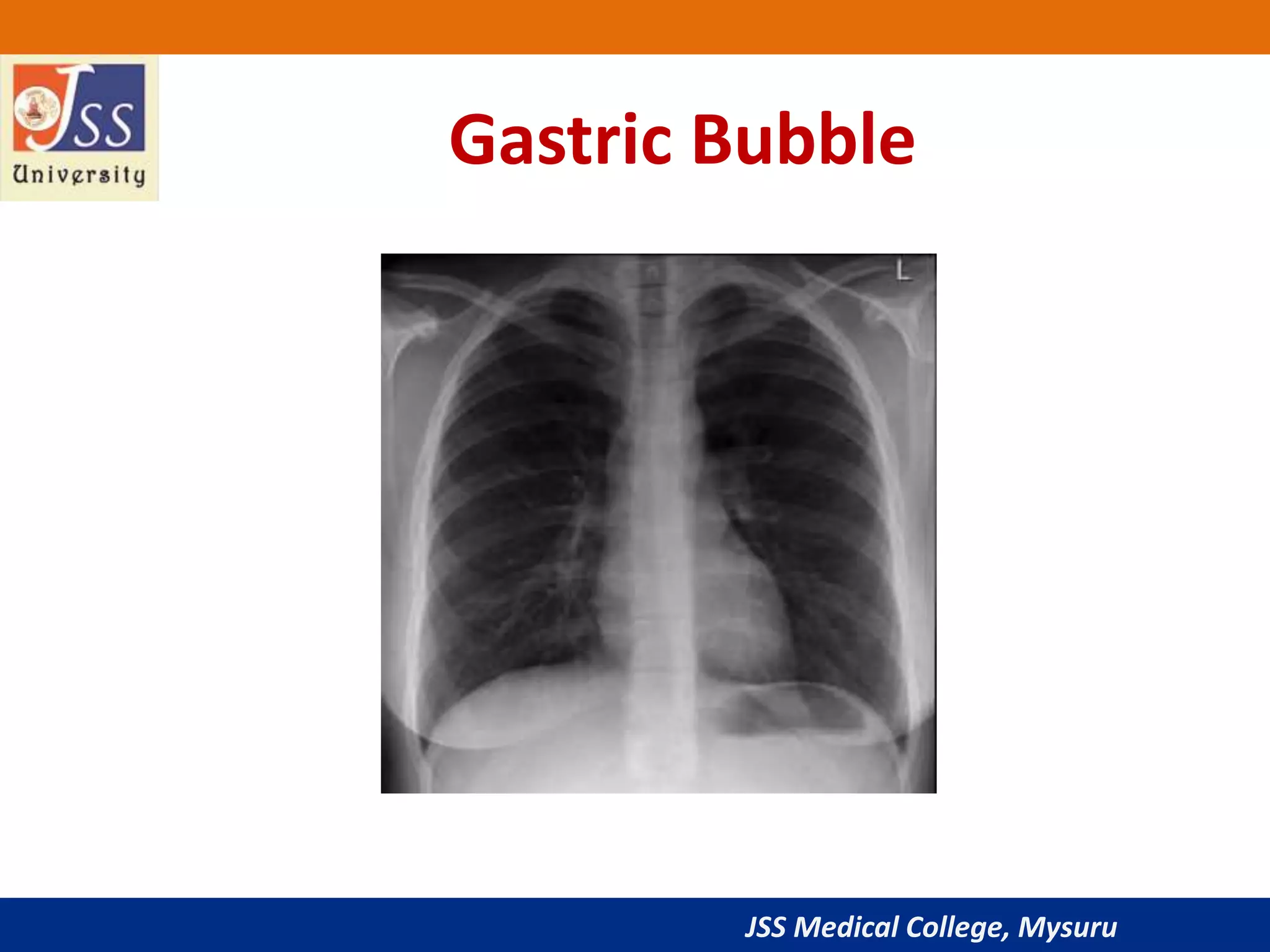 JSS Medical College, Mysuru
Gastric Bubble
 