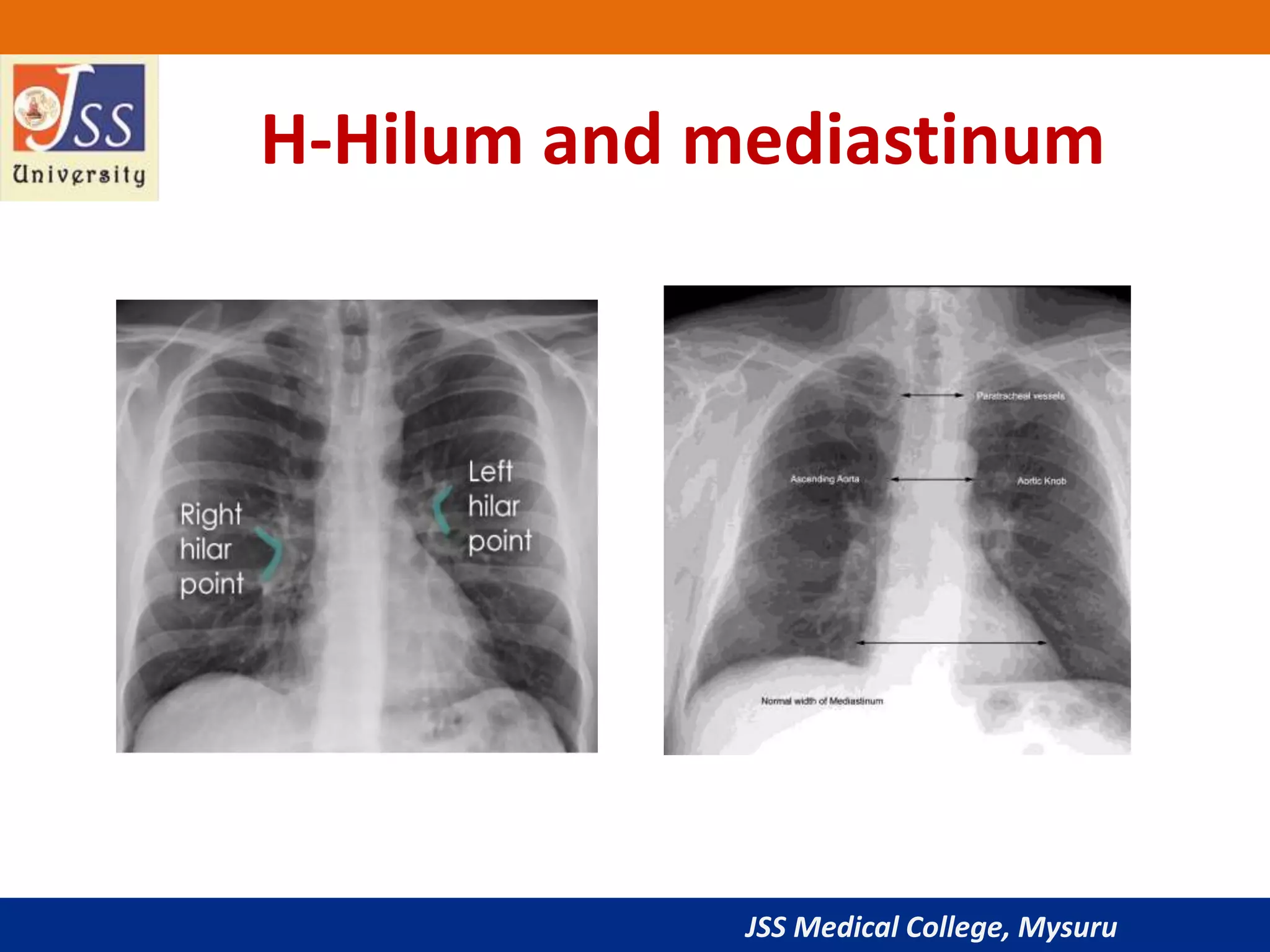 JSS Medical College, Mysuru
H-Hilum and mediastinum
 