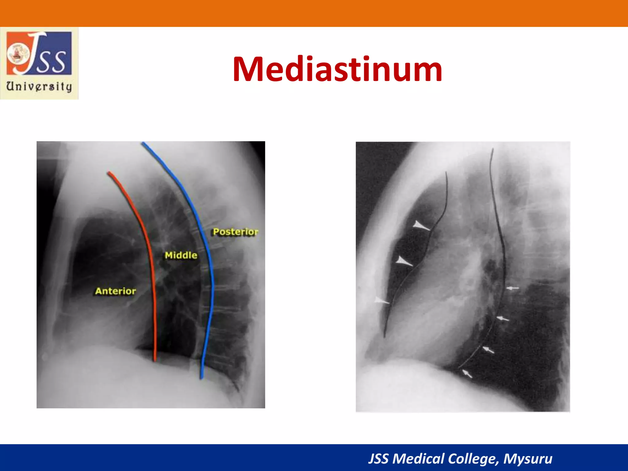 JSS Medical College, Mysuru
Mediastinum
 