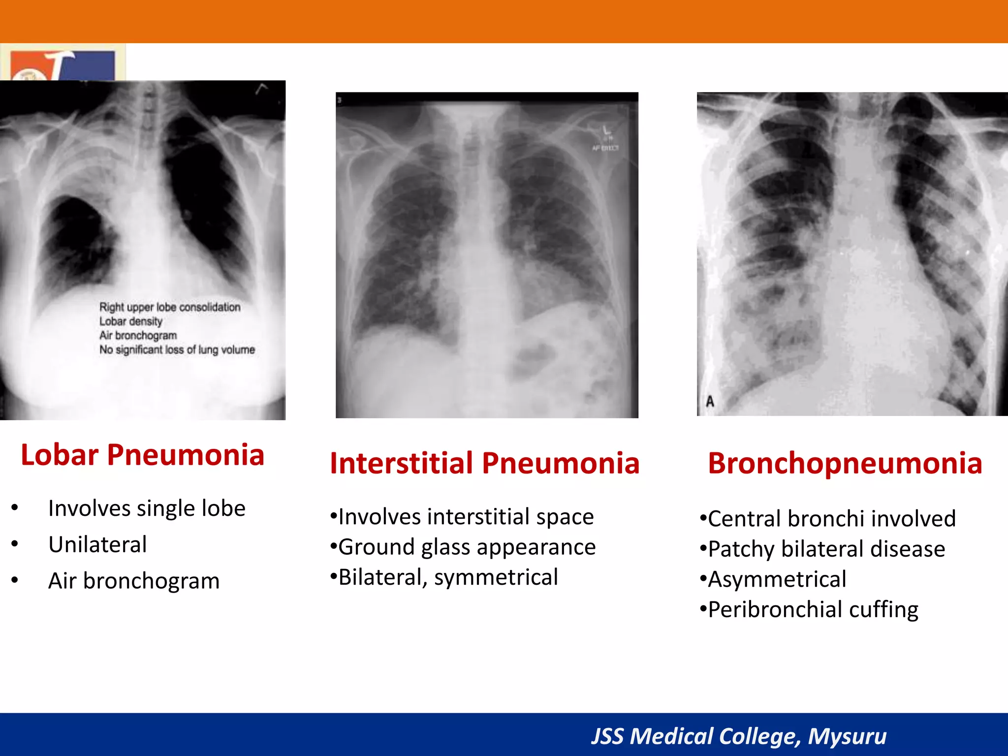 JSS Medical College, Mysuru
Lobar Pneumonia
• Involves single lobe
• Unilateral
• Air bronchogram
Interstitial Pneumonia
•Involves interstitial space
•Ground glass appearance
•Bilateral, symmetrical
Bronchopneumonia
•Central bronchi involved
•Patchy bilateral disease
•Asymmetrical
•Peribronchial cuffing
 