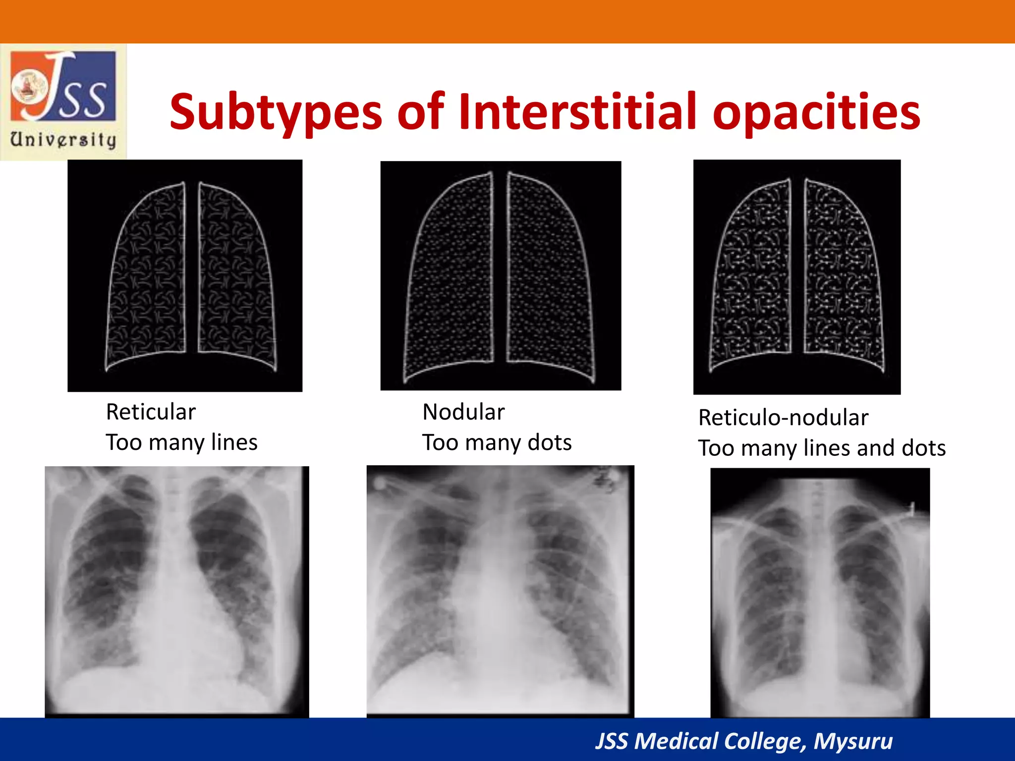 JSS Medical College, Mysuru
Subtypes of Interstitial opacities
Reticular
Too many lines
Nodular
Too many dots
Reticulo-nodular
Too many lines and dots
 