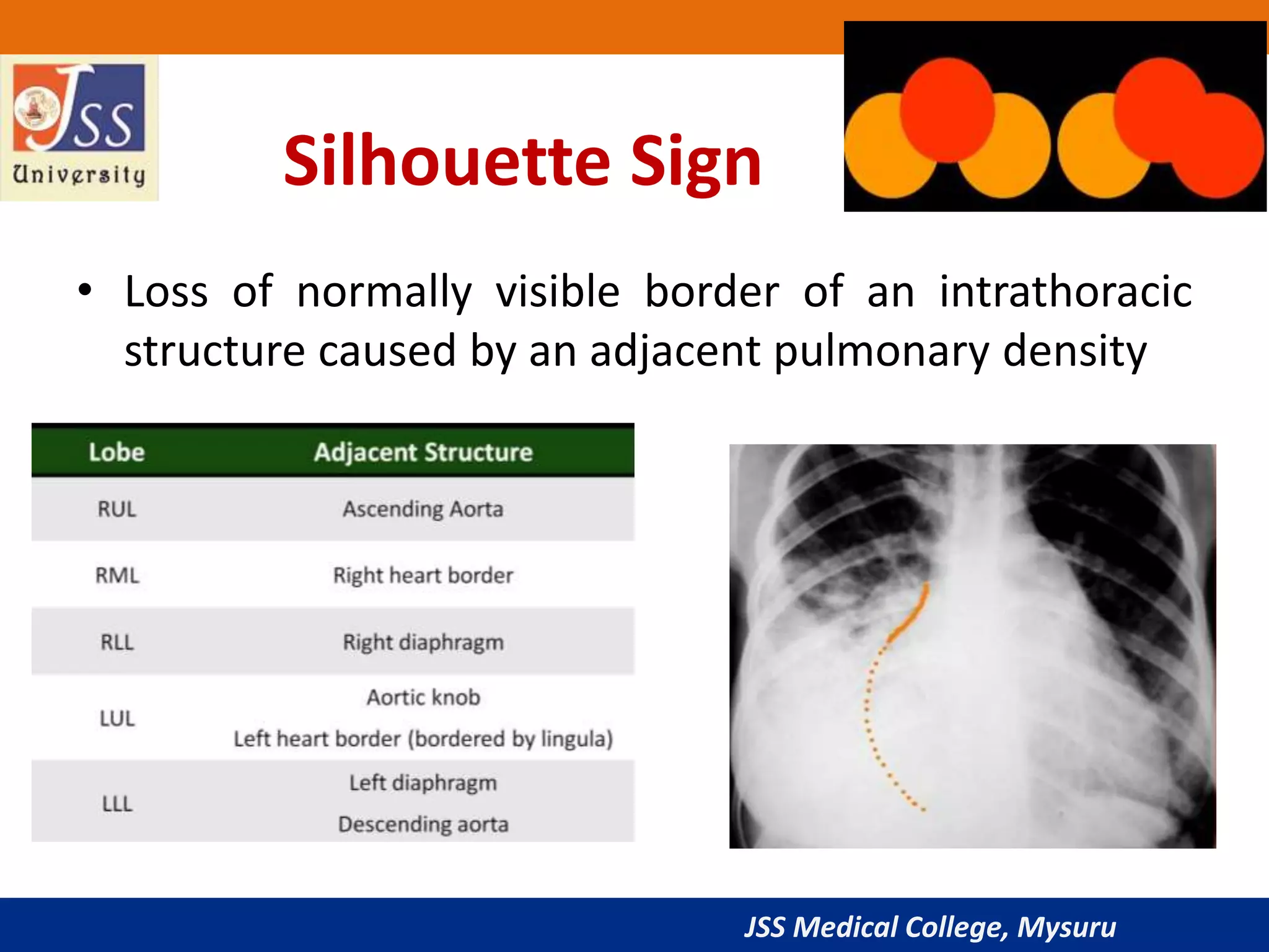 JSS Medical College, Mysuru
Silhouette Sign
• Loss of normally visible border of an intrathoracic
structure caused by an adjacent pulmonary density
 