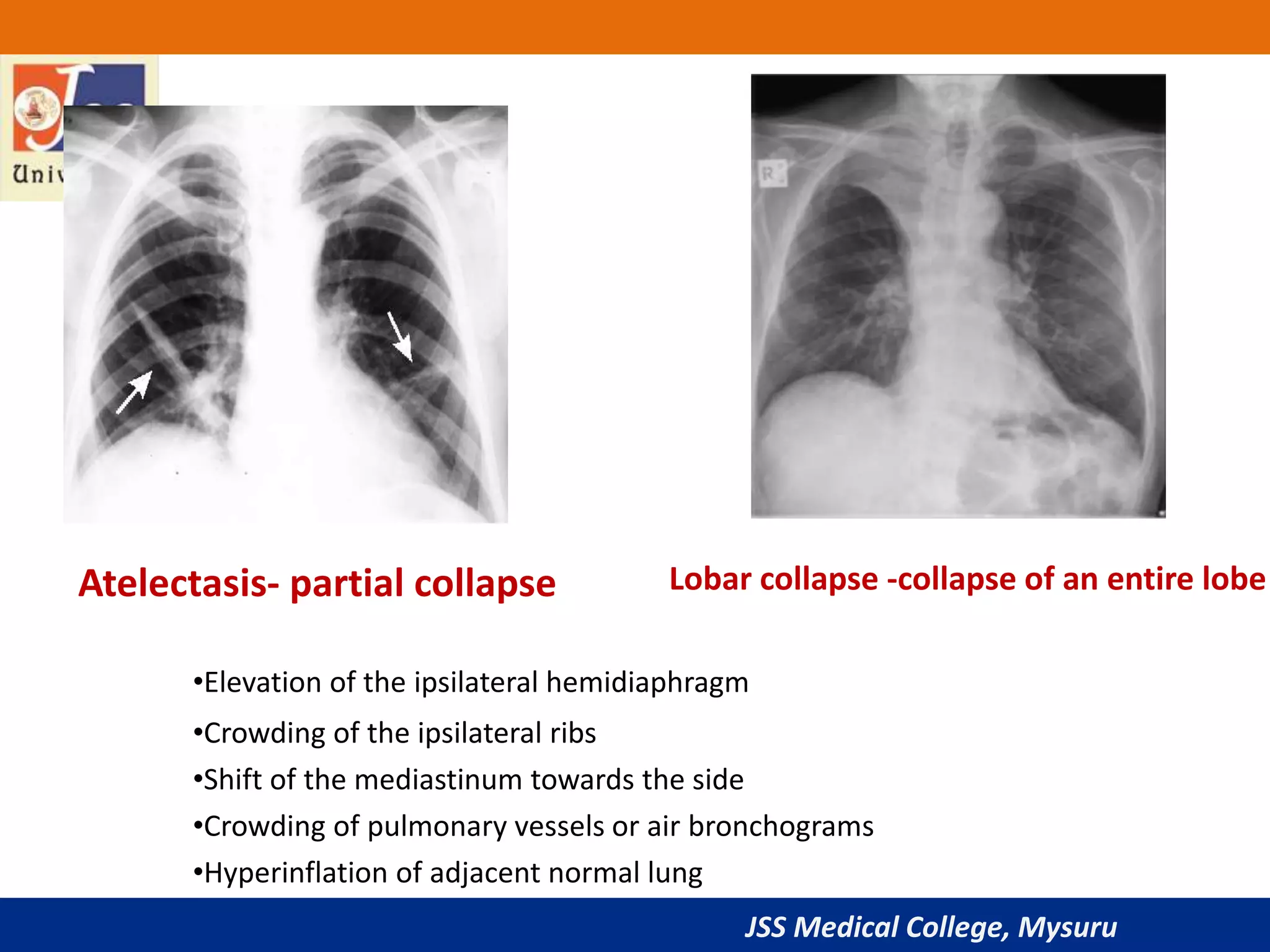 JSS Medical College, Mysuru
Atelectasis- partial collapse Lobar collapse -collapse of an entire lobe
•Elevation of the ipsilateral hemidiaphragm
•Crowding of the ipsilateral ribs
•Shift of the mediastinum towards the side
•Crowding of pulmonary vessels or air bronchograms
•Hyperinflation of adjacent normal lung
 