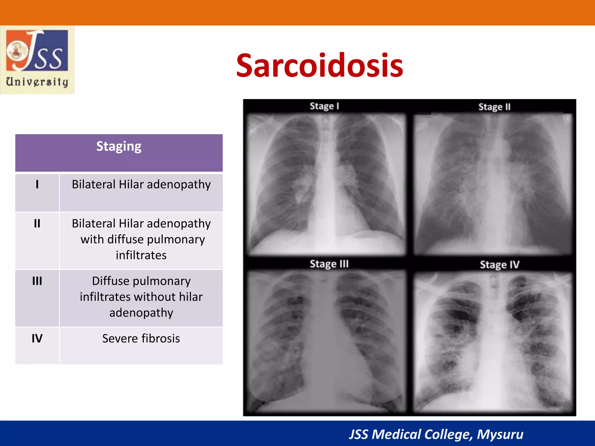 JSS Medical College, Mysuru
Sarcoidosis
Staging
I Bilateral Hilar adenopathy
II Bilateral Hilar adenopathy
with diffuse pulmonary
infiltrates
III Diffuse pulmonary
infiltrates without hilar
adenopathy
IV Severe fibrosis
 