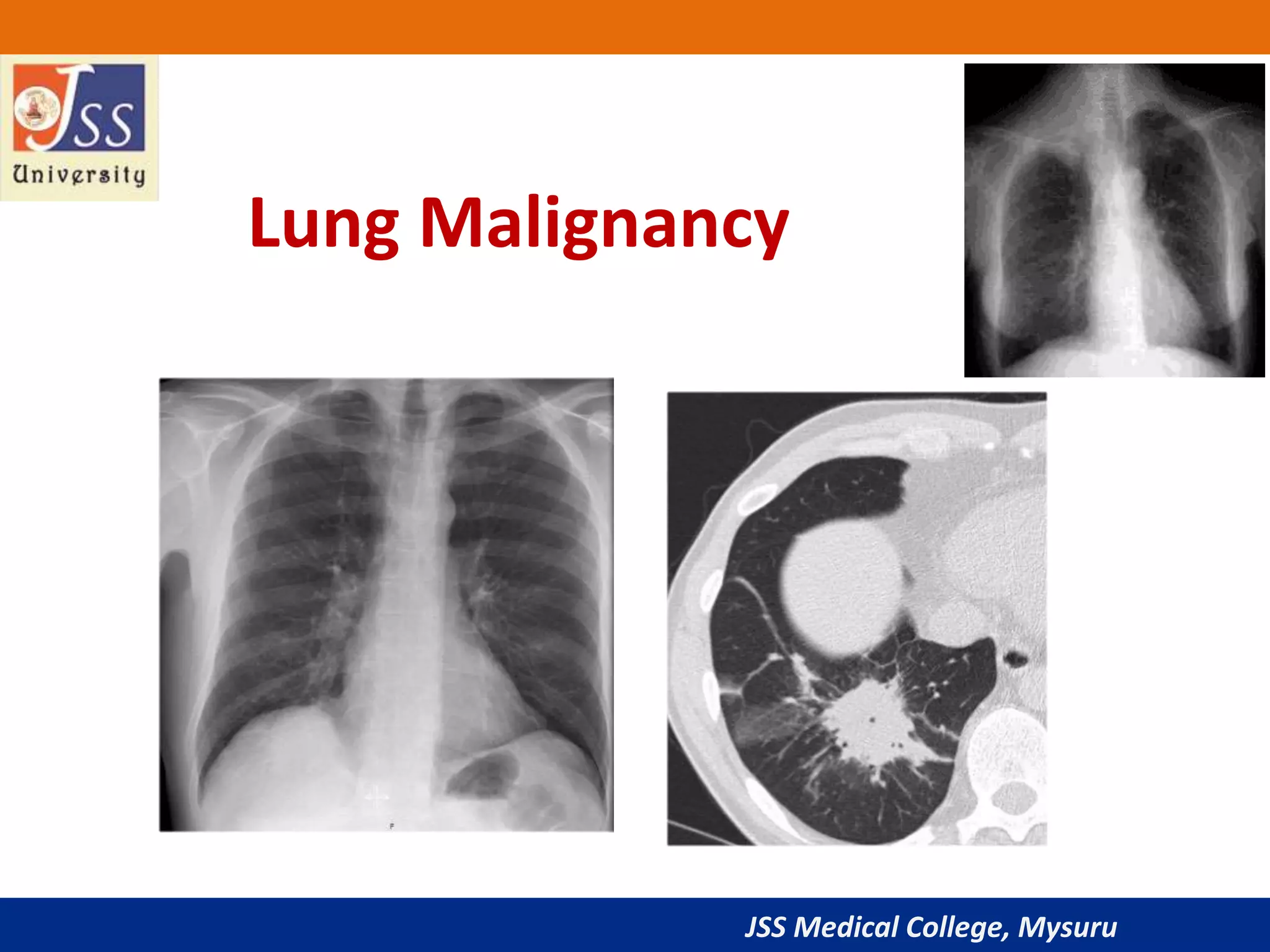 JSS Medical College, Mysuru
Lung Malignancy
 