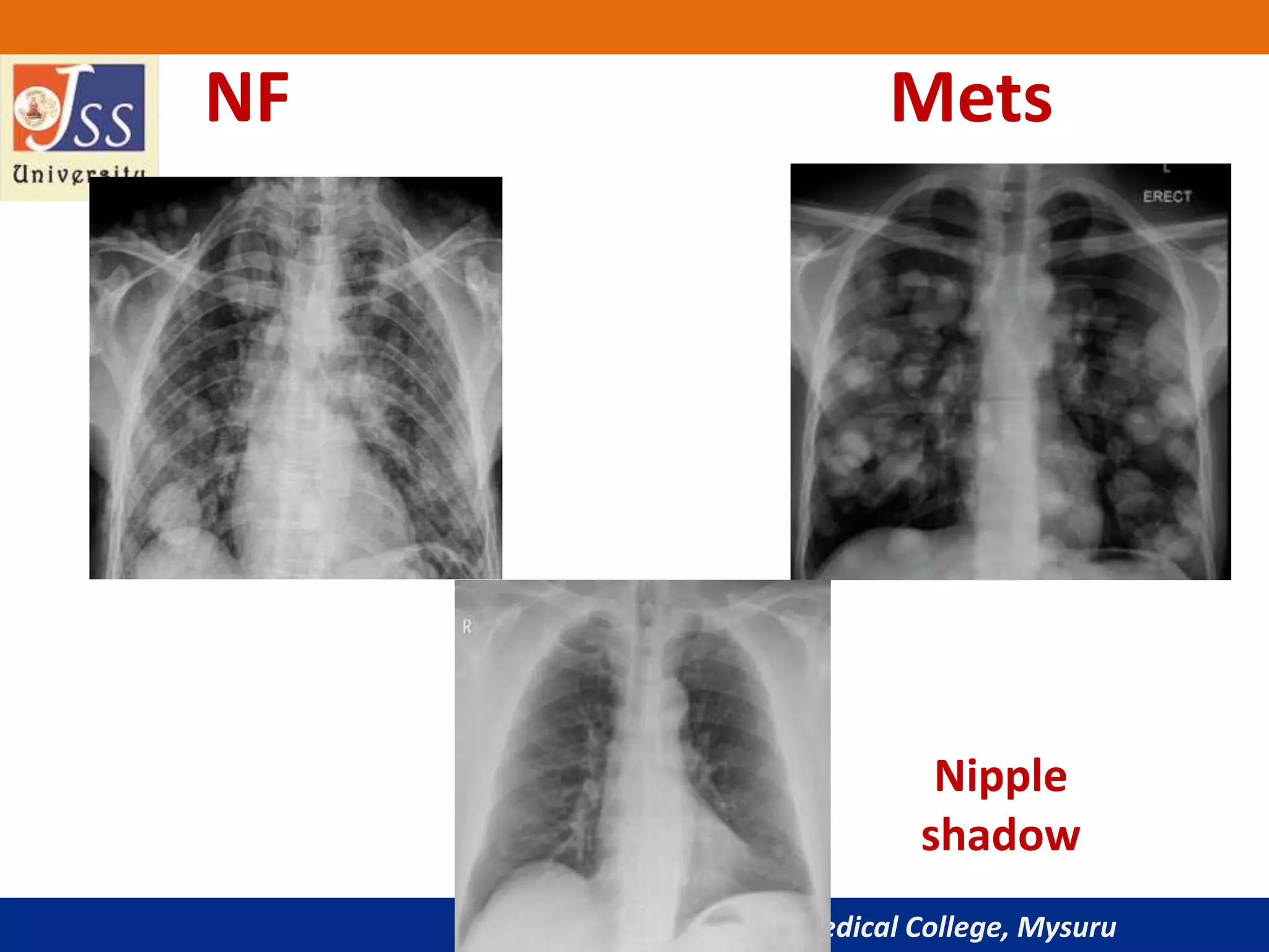 JSS Medical College, Mysuru
NF Mets
Nipple
shadow
 