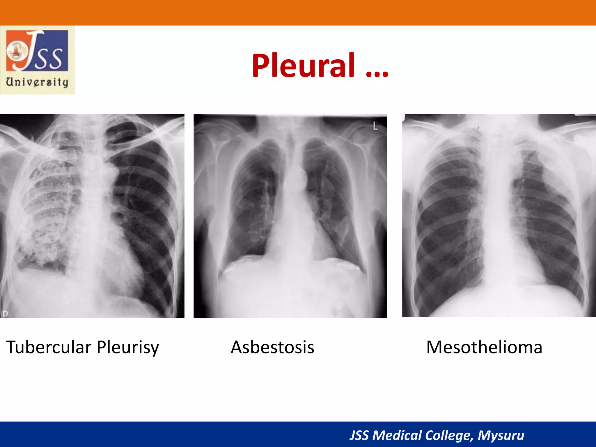 JSS Medical College, Mysuru
Pleural …
Tubercular Pleurisy Asbestosis Mesothelioma
 