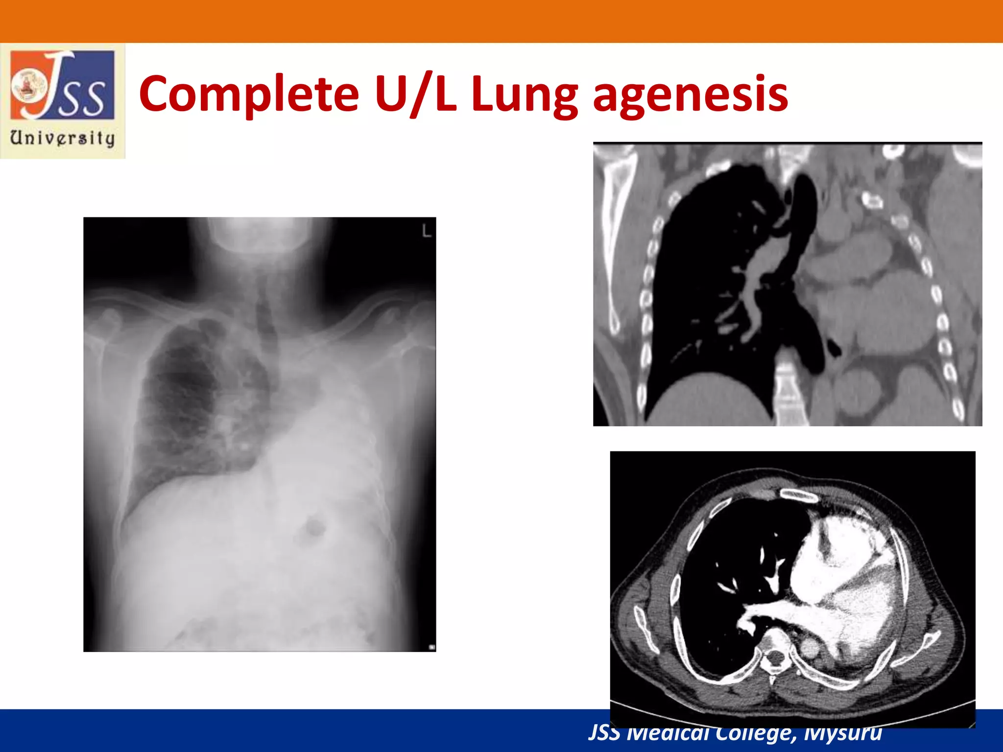 JSS Medical College, Mysuru
Complete U/L Lung agenesis
 