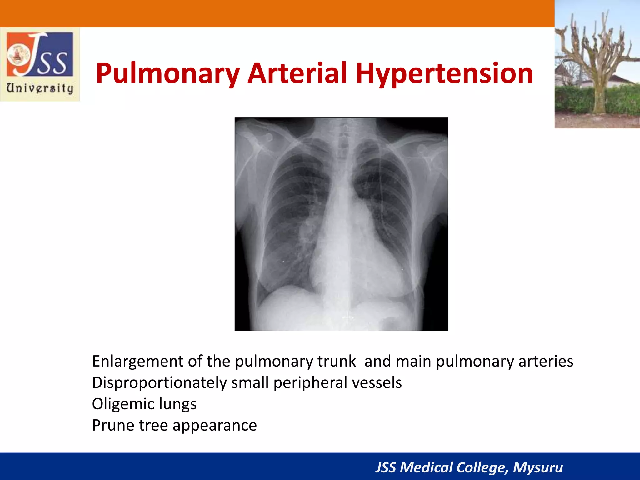 JSS Medical College, Mysuru
Pulmonary Arterial Hypertension
Enlargement of the pulmonary trunk and main pulmonary arteries
Disproportionately small peripheral vessels
Oligemic lungs
Prune tree appearance
 