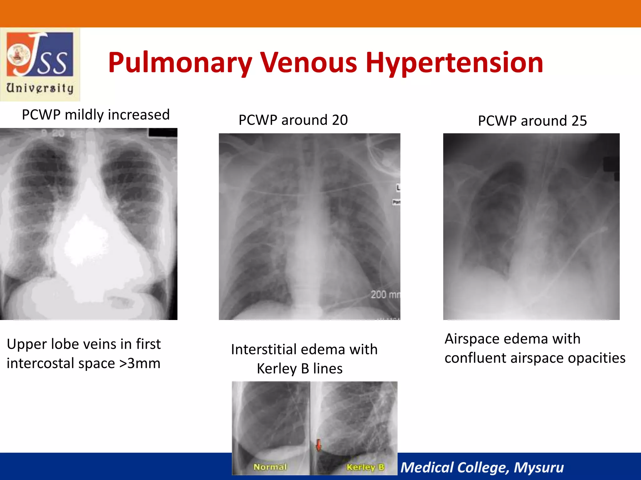 JSS Medical College, Mysuru
Pulmonary Venous Hypertension
Upper lobe veins in first
intercostal space >3mm
Interstitial edema with
Kerley B lines
Airspace edema with
confluent airspace opacities
PCWP mildly increased PCWP around 20 PCWP around 25
 