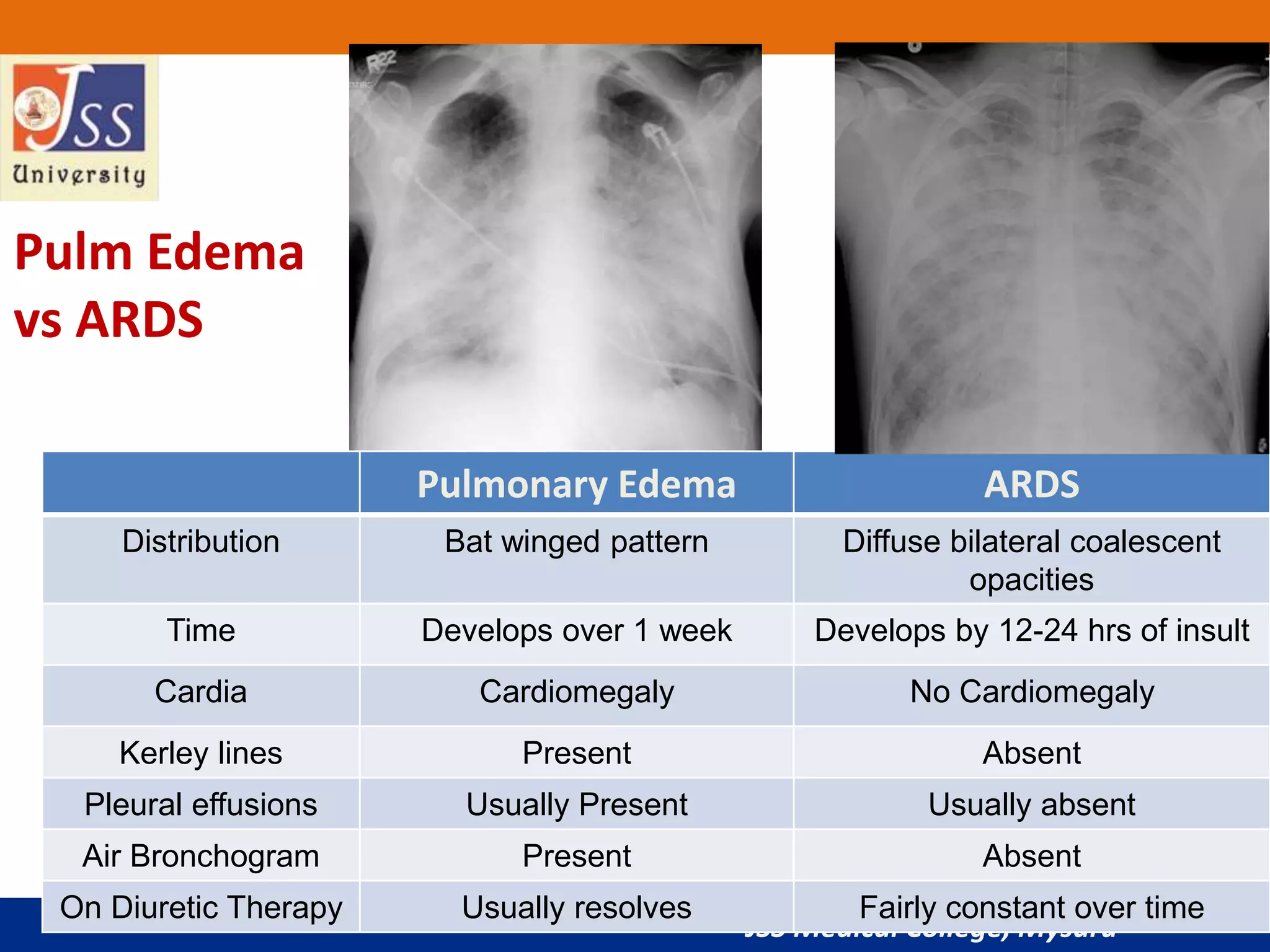 JSS Medical College, Mysuru
Pulmonary Edema ARDS
Distribution Bat winged pattern Diffuse bilateral coalescent
opacities
Time Develops over 1 week Develops by 12-24 hrs of insult
Cardia Cardiomegaly No Cardiomegaly
Kerley lines Present Absent
Pleural effusions Usually Present Usually absent
Air Bronchogram Present Absent
On Diuretic Therapy Usually resolves Fairly constant over time
Pulm Edema
vs ARDS
 